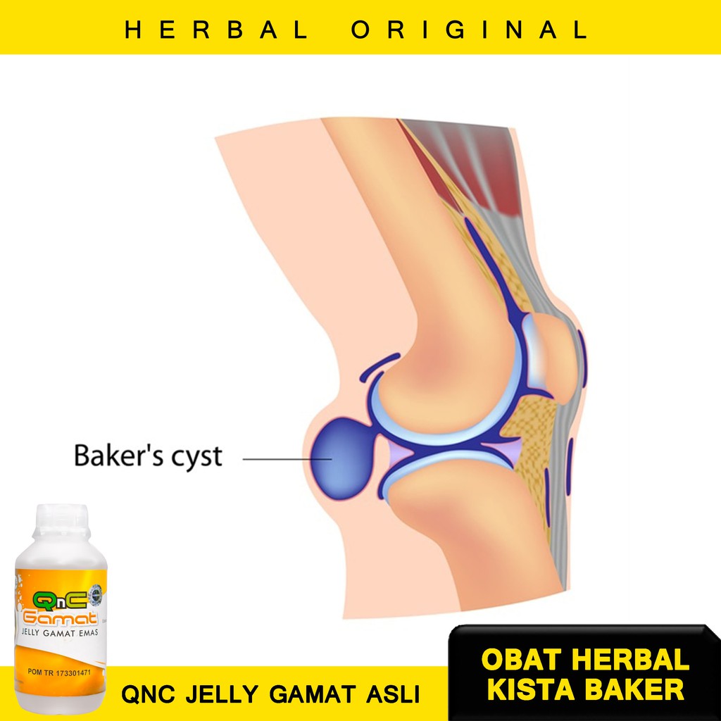 Obat Tradisional Kista Baker, Obat Herbal Kista Baker, Kista Baker, Kista Poplitea, Benjolan Baker