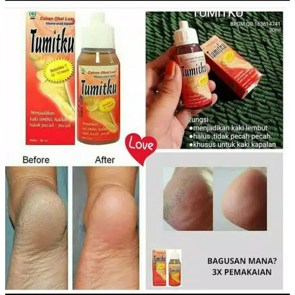 TUMITKU MINYAK OLES 30ML MENGATASI KAKI KERING KASAR PECAH-PECAH / KAPALAN SECARA INSTAN BPOM