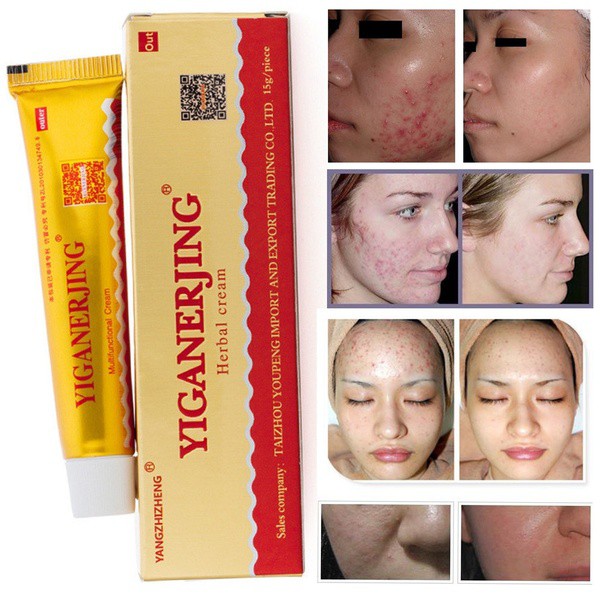 Salep Yiganerjing | Cream Yiganerjing 15Gram | Salep Eksim Jamur Psoriasis Dermatitis | Salep Herbal