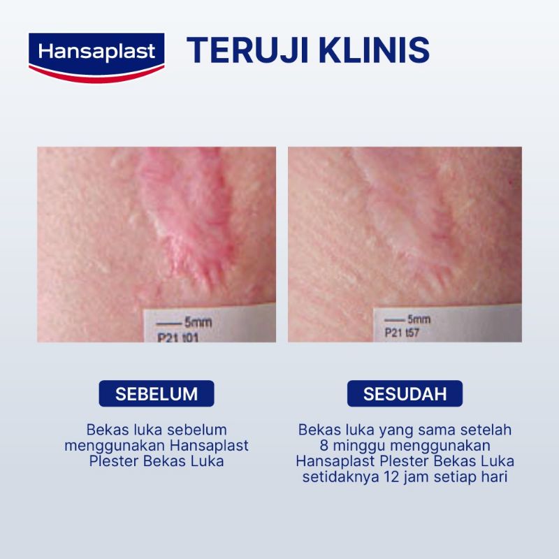 Hansaplast plester bekas luka keloid XL satuan