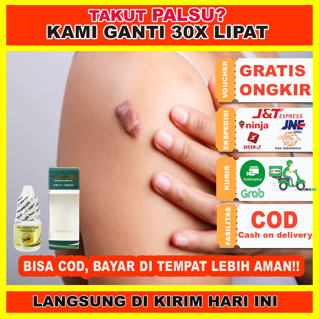 PROPOLIS BRAZIL SM/ Obat Keloid/ Obat Benjolan Keloid/ Obat Penghilang Keloid/ PROPOLIS SM