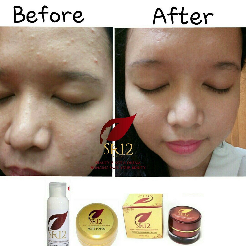 SR12 Acne Treatment Cream - Perawatan Jerawat Untuk Muka Wajah - SR12 Skincare - Skin Care