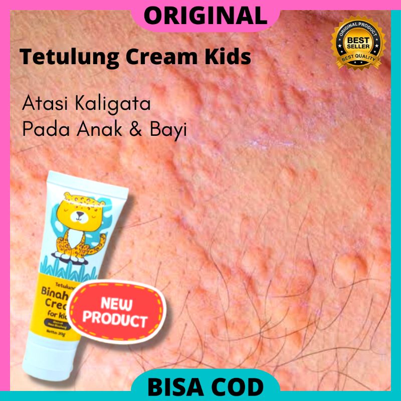 Cream Binahong Kids Krim Untuk Biduran Anak Herbal - Cream Obat Gatal Biduran Bentol Pada Badan Anak