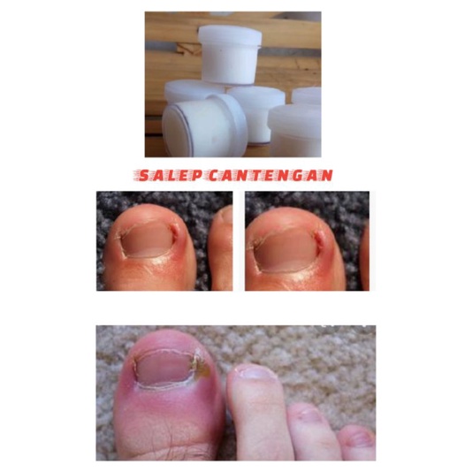 salep cantengan kuku
