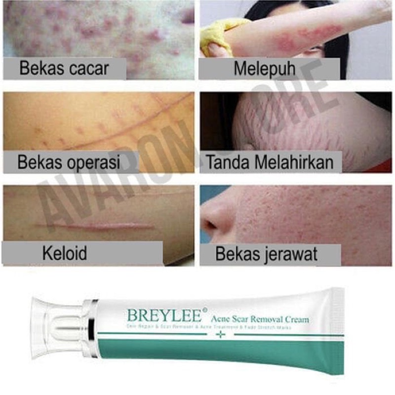 BREYLEE Acne Cream 30gr - Cream Scar Removal