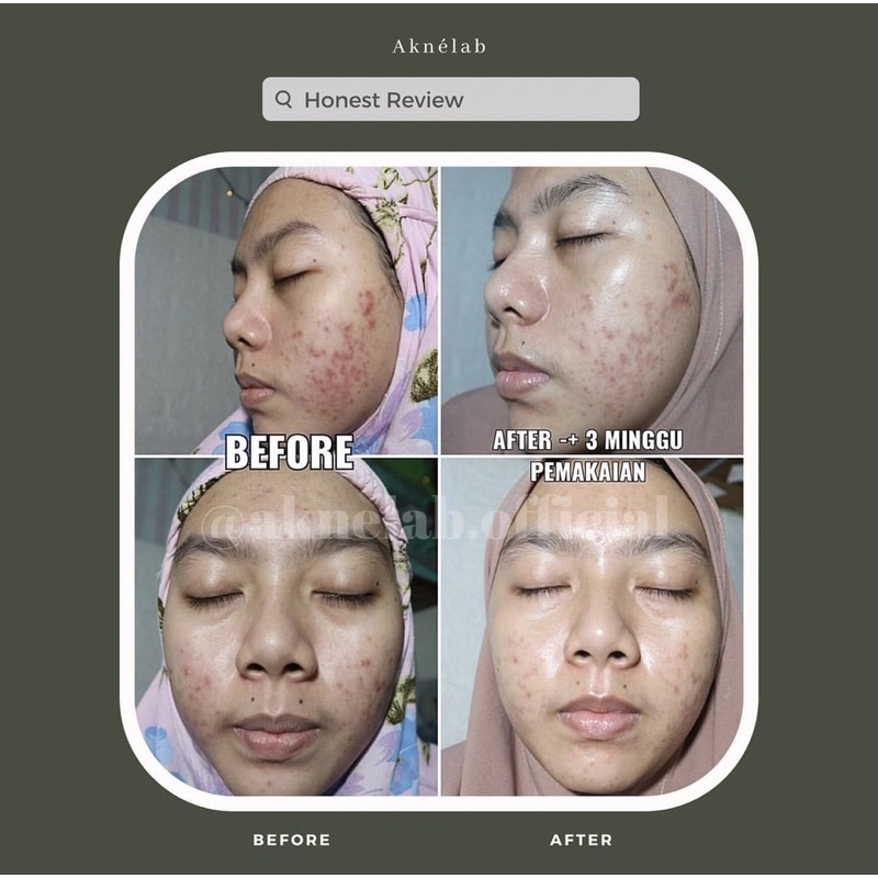 Brightening Acne Series Aknèlab (1 paket) mencerahkan &amp; menghilangkan bekas jerawat