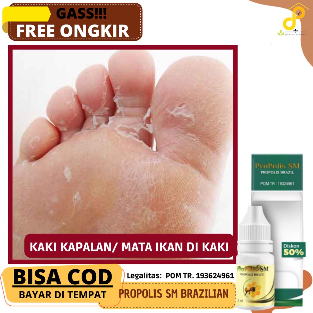 Cara Cepat Menghilangkan Kaki Kapalan - Obat Menghilangkan kaki Kapalan yang sudah lama - Telapak ka