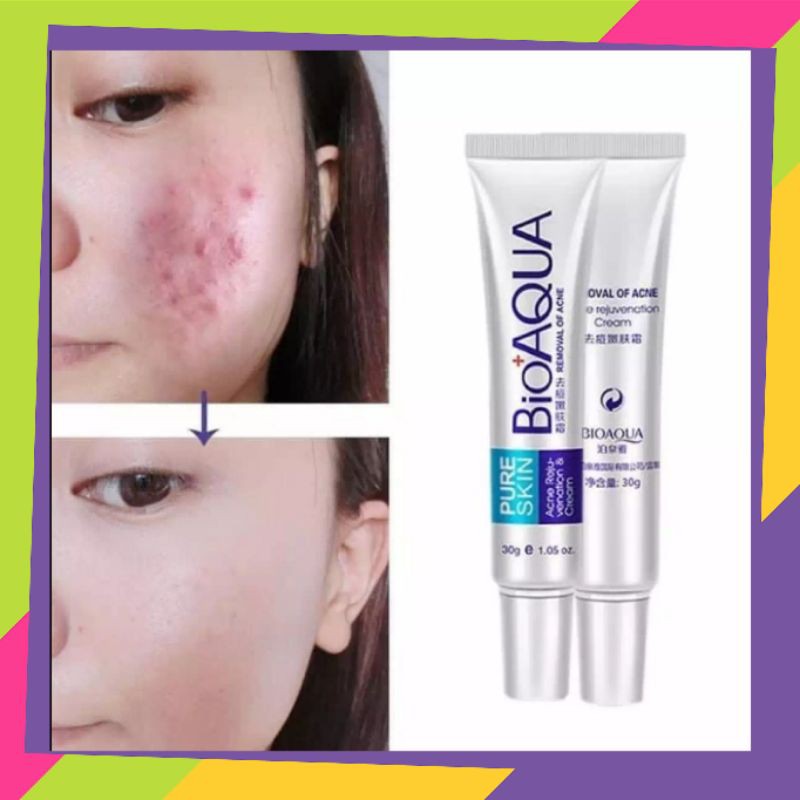 KrimJerawat Bioaqua Pure Skin Original - OBAT Jerawat Paling Ampuh - Serum Jerawat Dan Bekas Jerawat