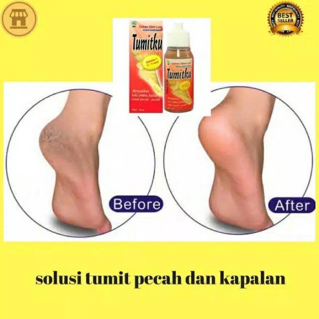 TUMIT OBAT KAKI PECAH2 OBAT KAKI PECAH2 DAN KERING AMPUH OBAT KAKI RAYAPAN KRONIS MURAH