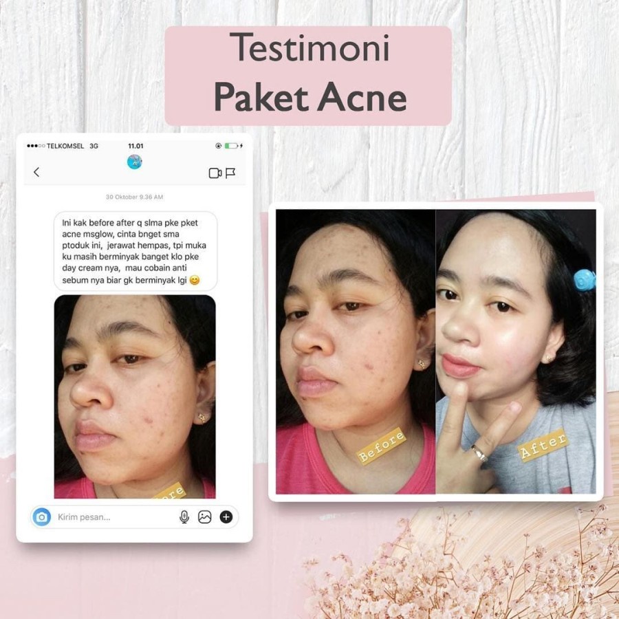 Ms Glow Paket Acne Series Free Pouch / Cream Penghilang Jerawat