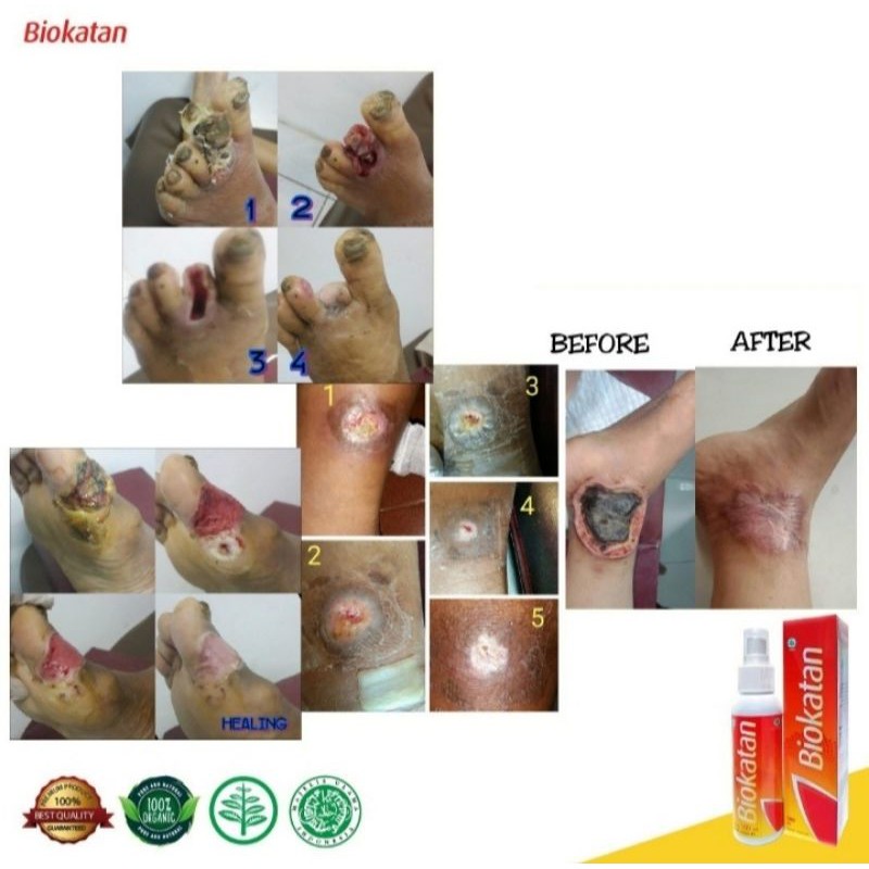 BIOKATAN obat luka diabetes herbal 100 ml