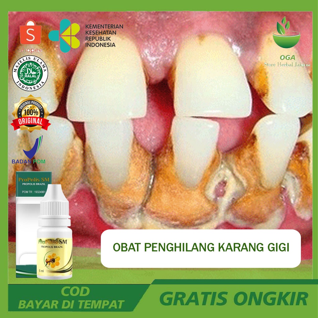 Obat Penghilang Karang Gigi, Menghilangkan Karang Gigi, Membersihkan Karang Gigi, Merontokan Karang 
