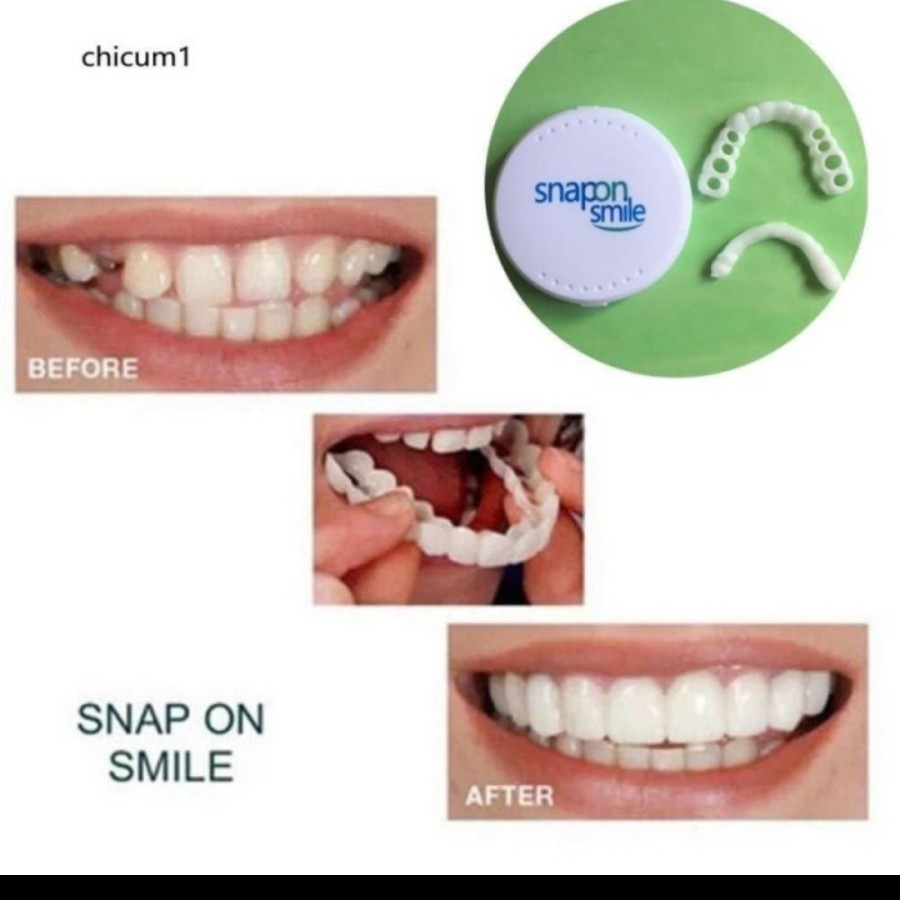 Snap On Smile Veneer Instan Gigi Palsu Tiruan Kesehatan Mulut Mouth Ok