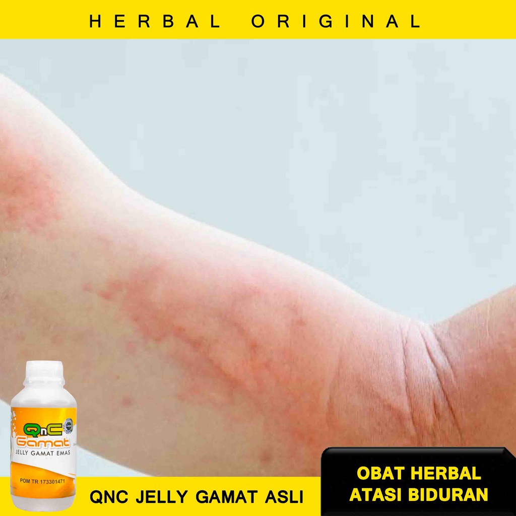 Obat Biduran Alami Obat Biduran Herbal Obat Biduran Anak Obat Biduran Tradisional Ruam Kulit Shopee Indonesia