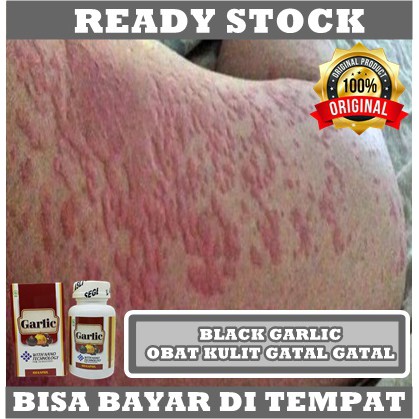 Obat Anti Alergi Gatal Herbal Pada Kulit - Obat Tradisional Alergi Debu, Obat Alergi Panas, Obat Alergi Dingin, Obat Alergi Makanan, Obat Biduran, Obat Eksim, Obat Skabies, Obat Herpes, Obat Iritasi Kulit Walatra Black Garlic 100 Kapsul BPOM