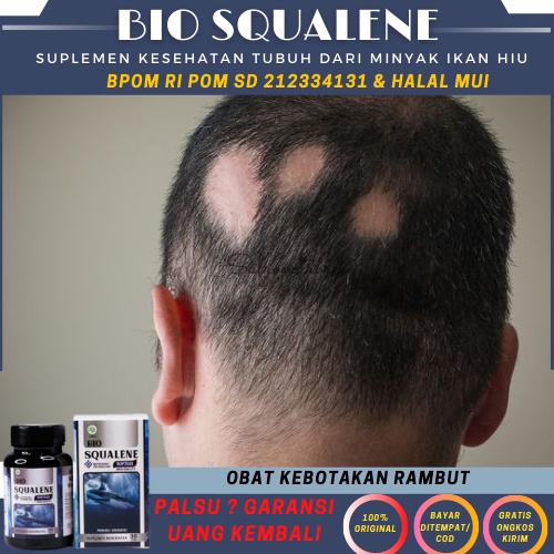 Obat Alopecia Rontok Parah Areata / Bio Squalene Softgel Original Alopecia Rontok Parah