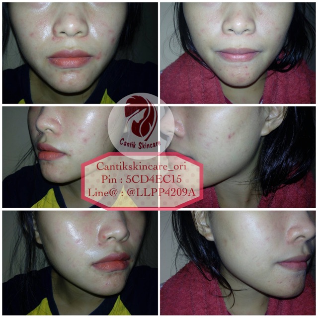 Paket wajah Acne Ms Glow by Cantikskincare ready stock
