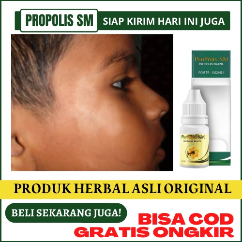 Obat Balas Bogo - Bercak Putih Di Wajah, Salap / Salep Balas Bogo Untuk Anak, Menghilangkan Panu Yan