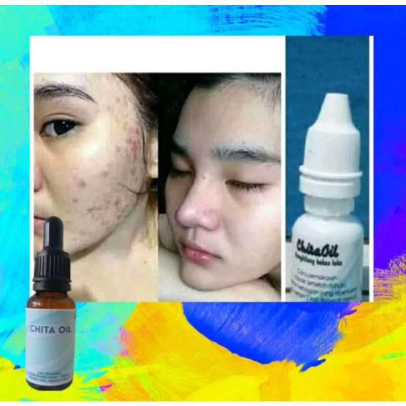 HOT PROMO Chita oil penghilang bekas luka keloid