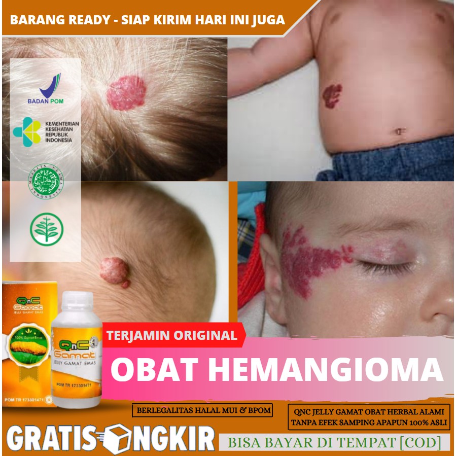 

Obat Hemangioma, Penghilang Daging Merah Menonjol Pada Bayi, Aman Alami 100% Asli QnC Jelly Gamat
