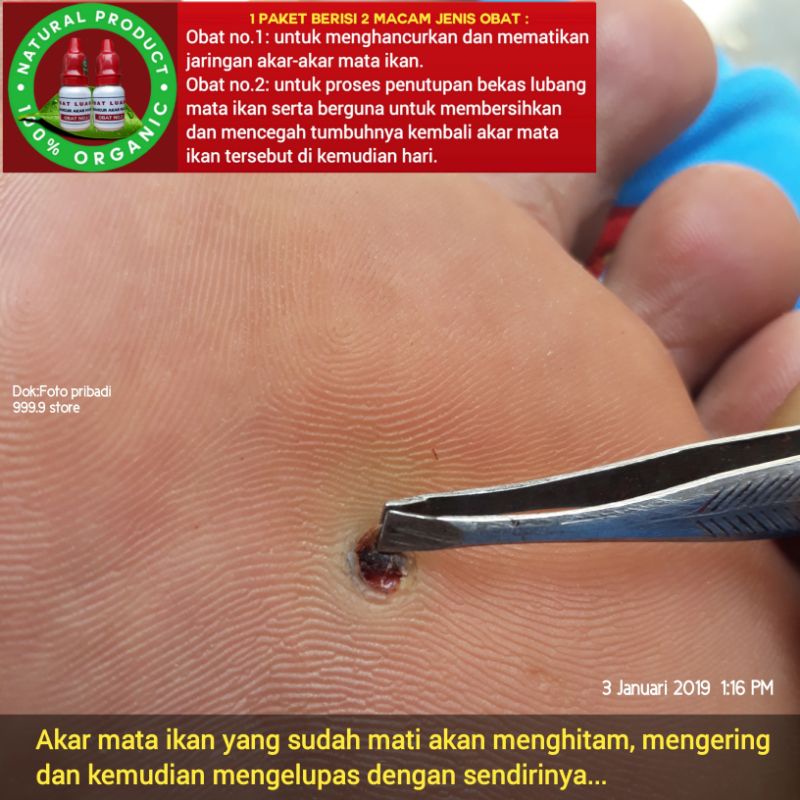 Obat penyakit mata ikan bukan plester salep callusol