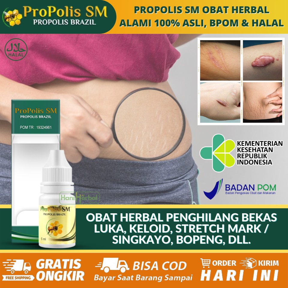 Obat Herbal Oles Penghilang Singkayo, Menghilangkan Stretch Mark / Garis Putih / Garis Hitam Dikulit