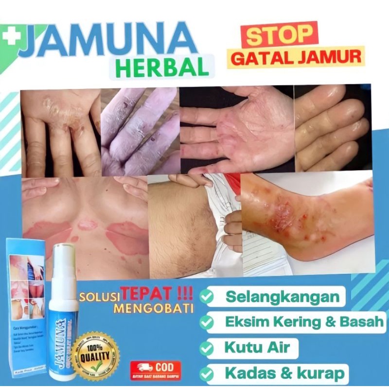 OBAT ALERGI GATAL KULIT PALING AMPUH HERBAL JAMUNA SPRAY ISI 25 ML / OBAT GATAL SELANGKANGAN  EKSIM 