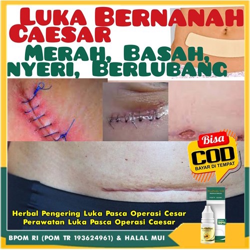 Herbal Pengering Luka Pasca Operasi Cesar, Perawatan Luka Pasca Operasi Caesar - Obat Salep Luka Cae