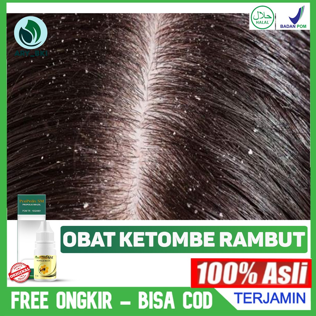 Obat Ketombe Rambut Menahun, Ketombe Kering, Basah, Berkerak, Kepala Gatal Banyak Dicari Propolis SM