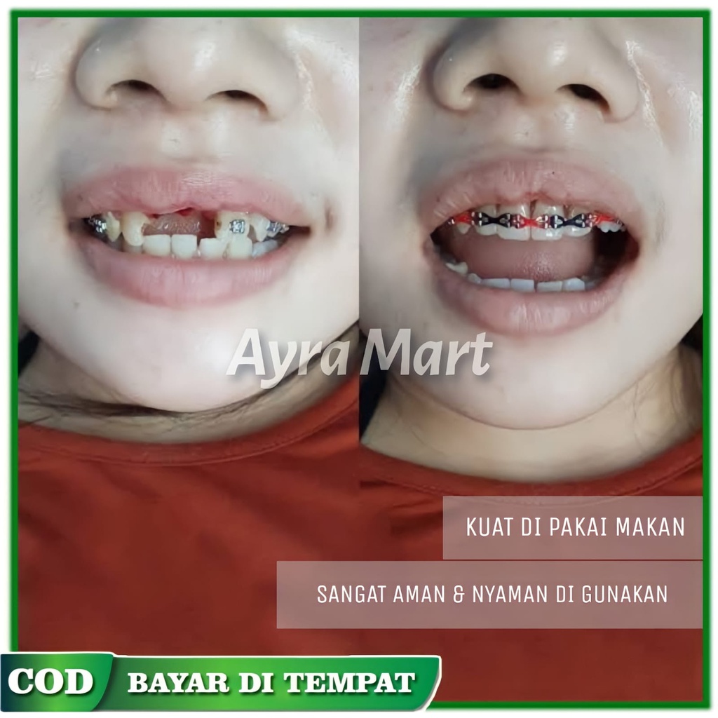 PERMANEN KUAT Gigi Palsu Penutup Ompong Depan Bawah Penambal Gigi Ompong Berlubang Patah Temptooth T