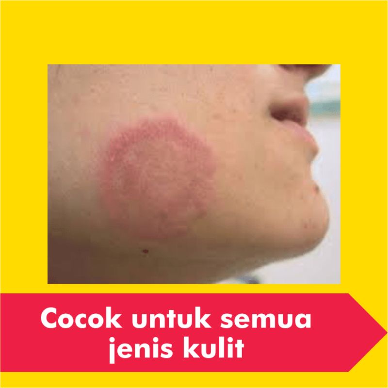Salep Obat Kurap Kudis Paling Ampuh Gatal Eksim Kutu Air Jamur Kulit Selangkangan Gatel Jerawat Panu-5