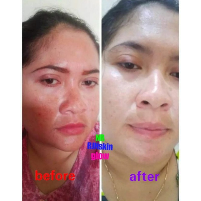 SALEP FLEK AMPUH || SALEP FLEK NIGHT || SALEP FLEK HITAM || SALEP MELASMA || CREAM FLEK || SALEP FLEK MEMBANDEL