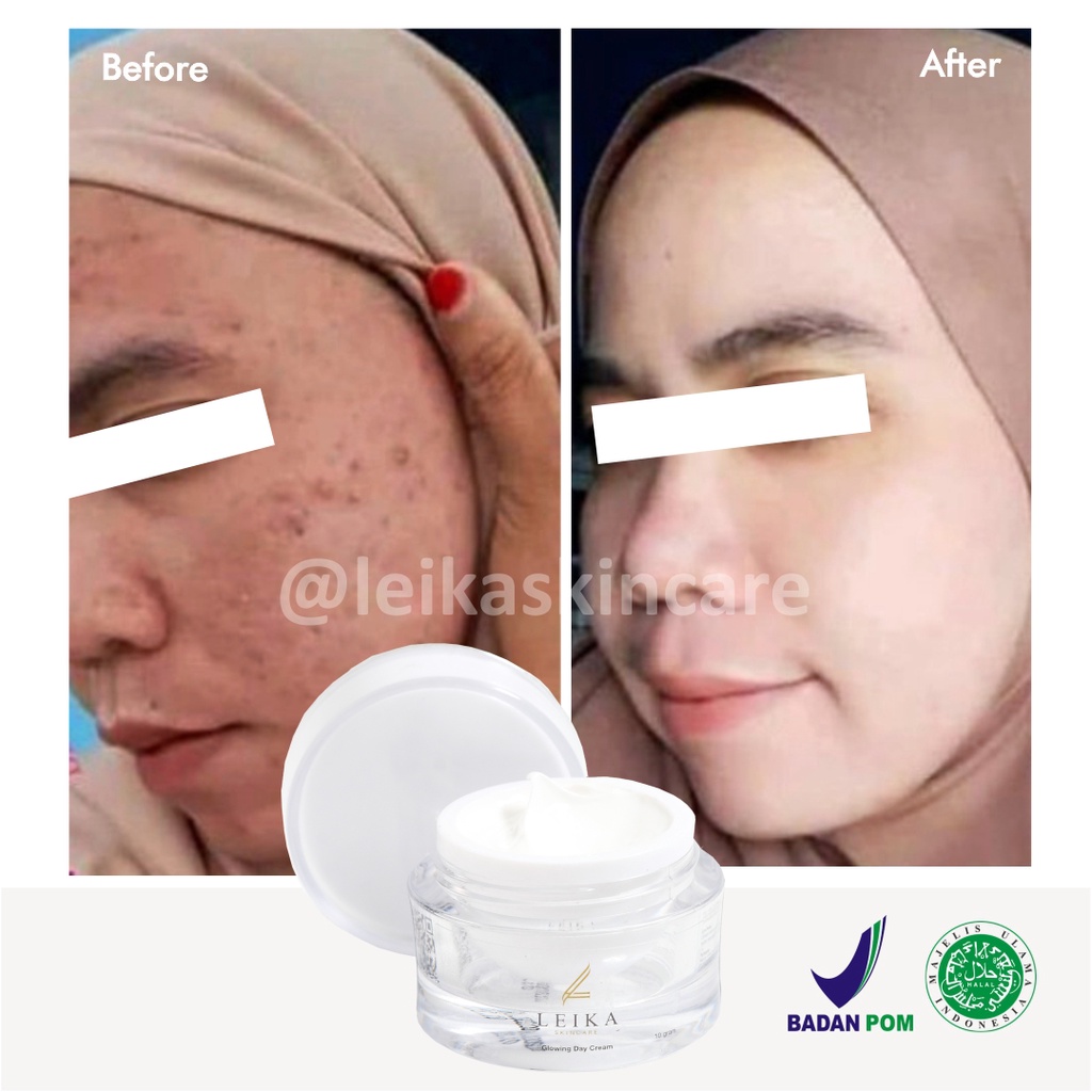 Obat Jerawat Paling Cepat dan Ampuh BPOM Obat untuk Kulit Wajah Berminyak Berjerawat Asli 100% dan Halal MUI Glowing Day Cream Leika Skincare 10gr Penghilang Jerawat Ampuh Aman Ori