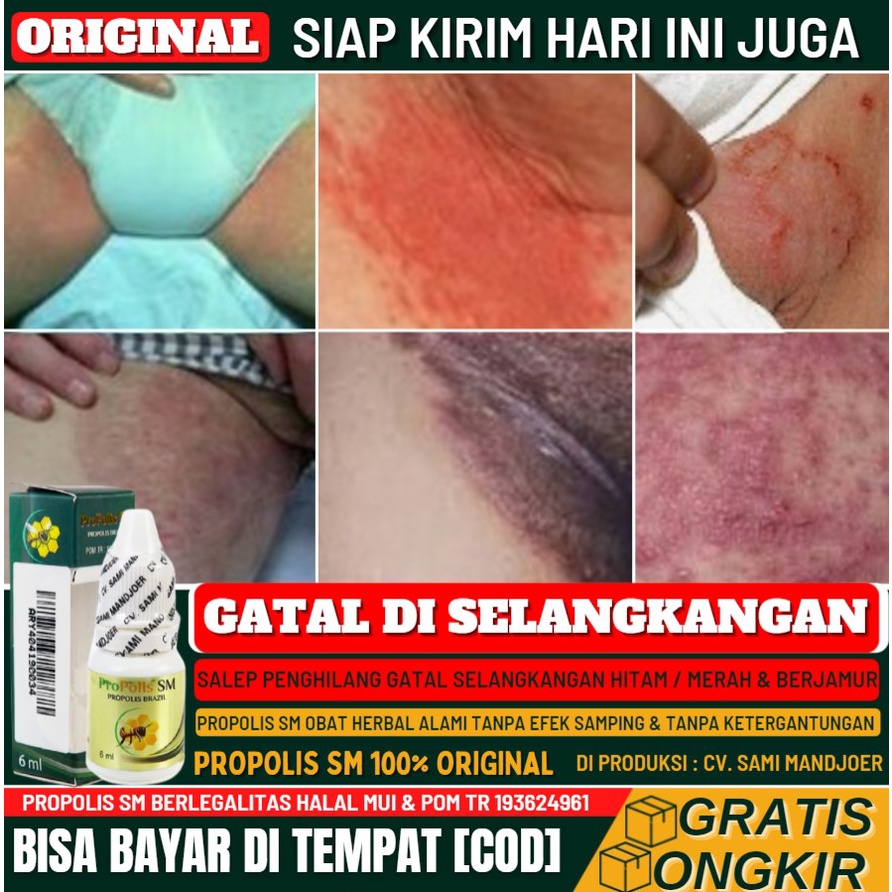 Obat Oles Penghilang Flek Hitam di Selangkangan 100% Alami, Peluntur Kulit Hitam Akibat Gatal Jamur,