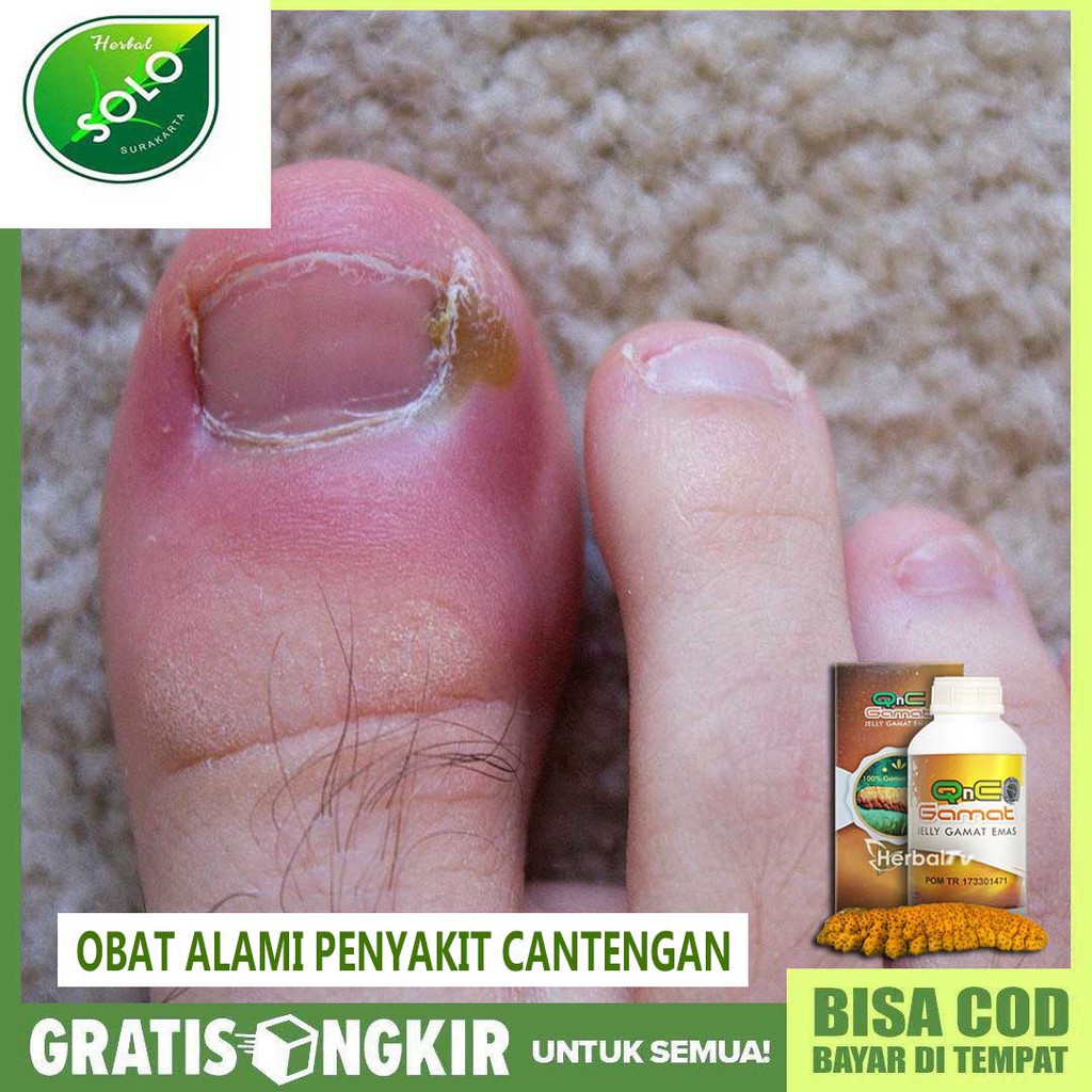 Jual Obat Cantengan Di Kaki Dan Tangan Cantengan Di Kuku Kaki And Tangan