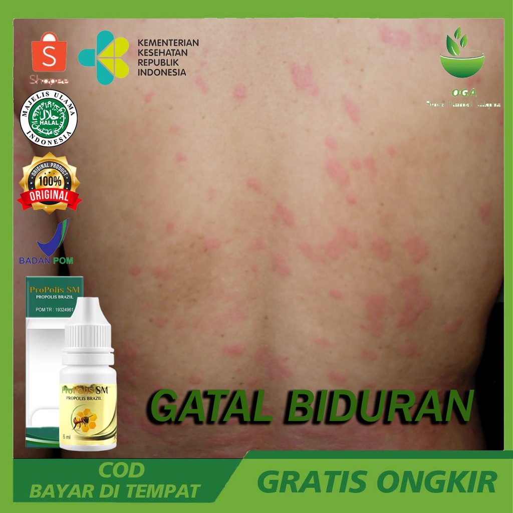 Obat Biduran Gatal, Biduran Alergi, Biduran Kronis, Biduran Menahun, Alergi Gatal Kulit, Alergi Ding