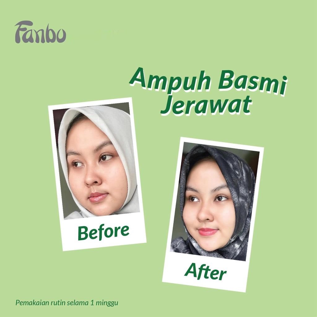 ★ BB ★ Fanbo Acne Solution Moisturizer Gel 40ml - Melembabkan dan Menyamarkan Bekas Jerawat - Noda Hitam