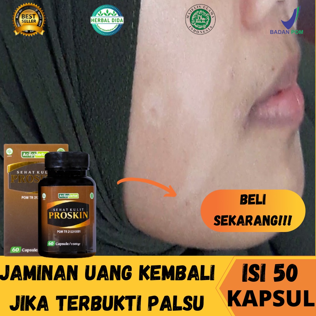 Obat Kulit Panu an, Obat Jamur Kulit Gatal Gatal Panu, Obat Kulit Panu, Obat Anti Panu & Jamur,  Men