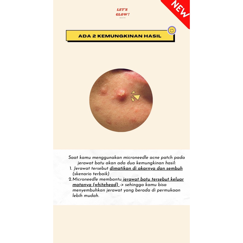 MICRONEEDLE ACNE PIMPLE PATCH PREMIUM MURAH