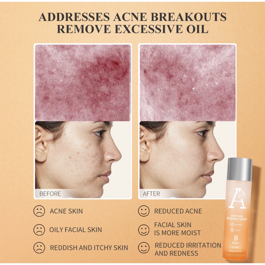 Premiere Beaute Acne Care Series - Serum Essence Toner Wajah Berjerawat &amp; Beruntusan