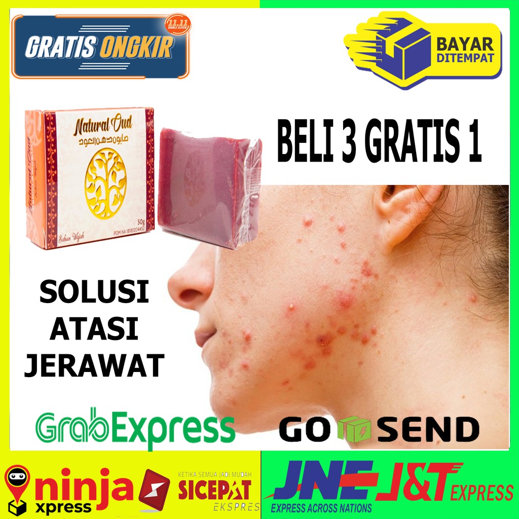 Obat Jerawat Alami 100%, Obat Jerawat Punggung, Obat Jerawat Batu, Obat Bekas Jerawat Hilang