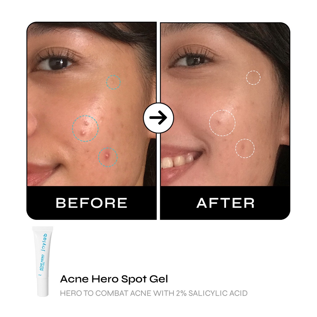 Joylab Acne Hero (Spot Gel/Serum)