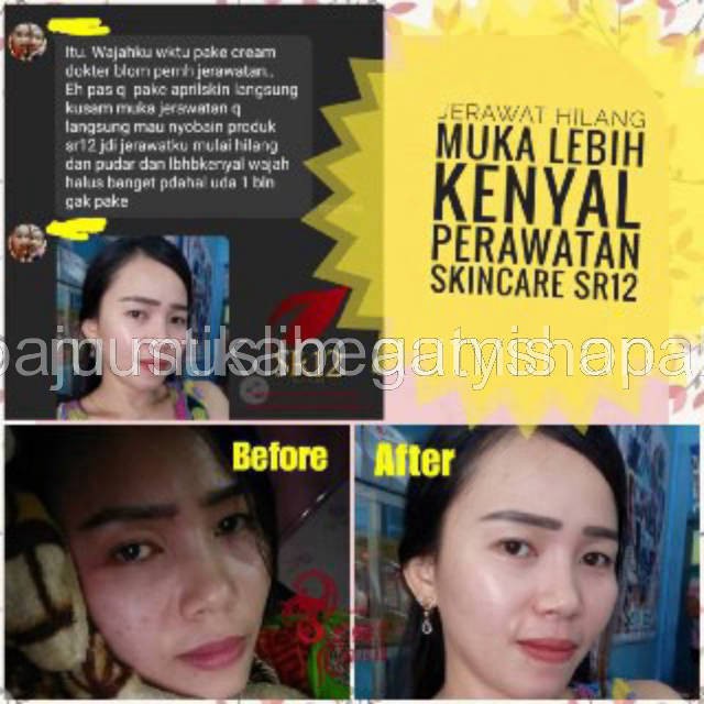 SPOT ESSENCE CREAM SR12 - TUMPAS BEKAS JERAWAT , FLEK HITAM &amp; NODA WAJAH