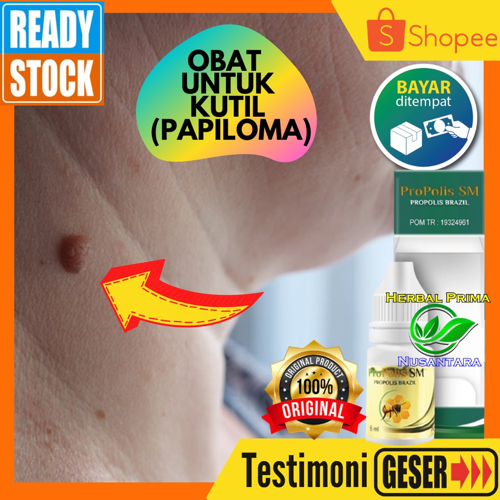 Obat Tetes Oles Kutil di Leher Papiloma, Obat Kutil Oles, Skin Tag, Daging Jadi, Tumbuh di Leher, Ob
