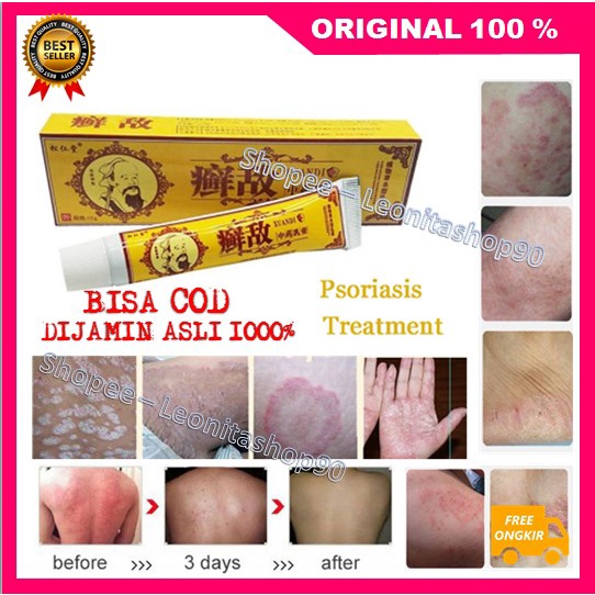 [BISA COD] Obat Herbal Cina Atasi Psoriasis Eksim Cream Psoriasis Ampuh ASLI