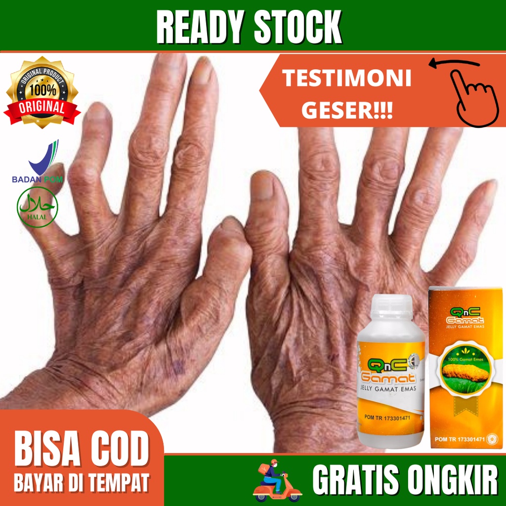 Obat Kusta, Lepra, Kusta Kering Dan Basah, Obat Kusta, Kerusakan Saraf, Luka Pada Kulit, Melemahnya 