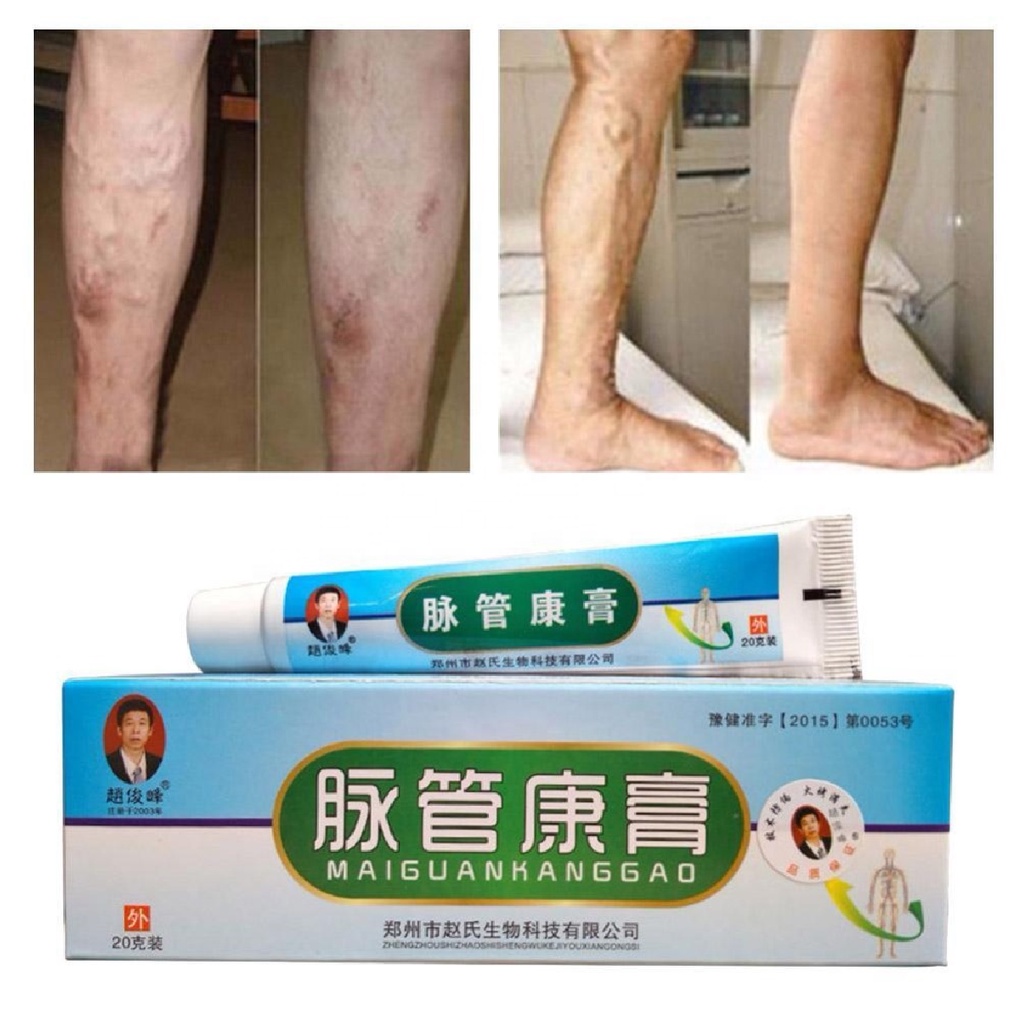 Salep Krim Varises Herbal Maiguankanggao - Varicose Veins Treatment