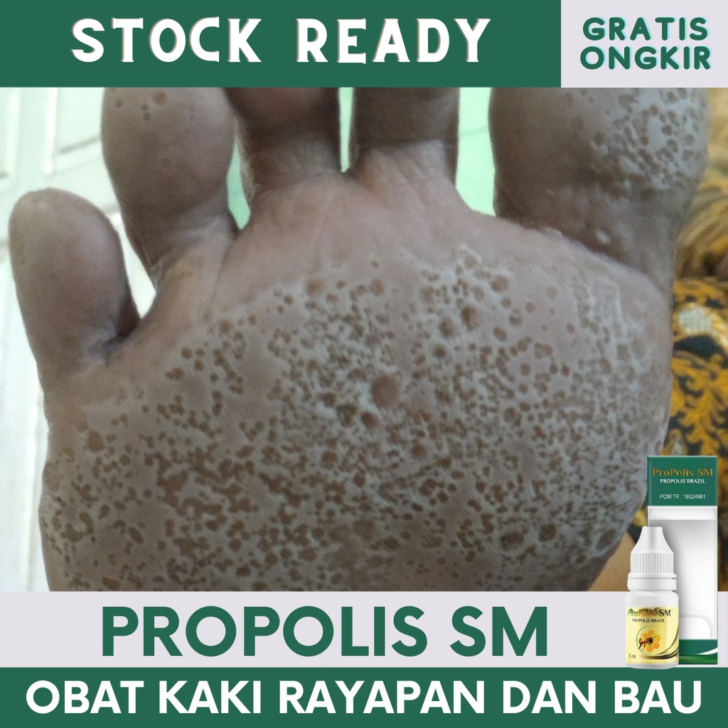 Obat Telapak Kaki Rayapan, Obat Oles Telapak Kaki Bolong Berlubang Lubang Kecil Dan Bau, Salep Untuk