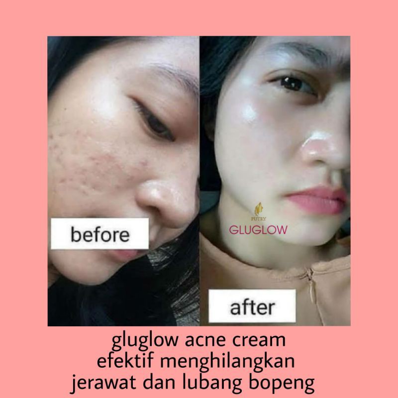 Cream Bopeng Dan Jerawat Ampuh Bpom Shopee Indonesia