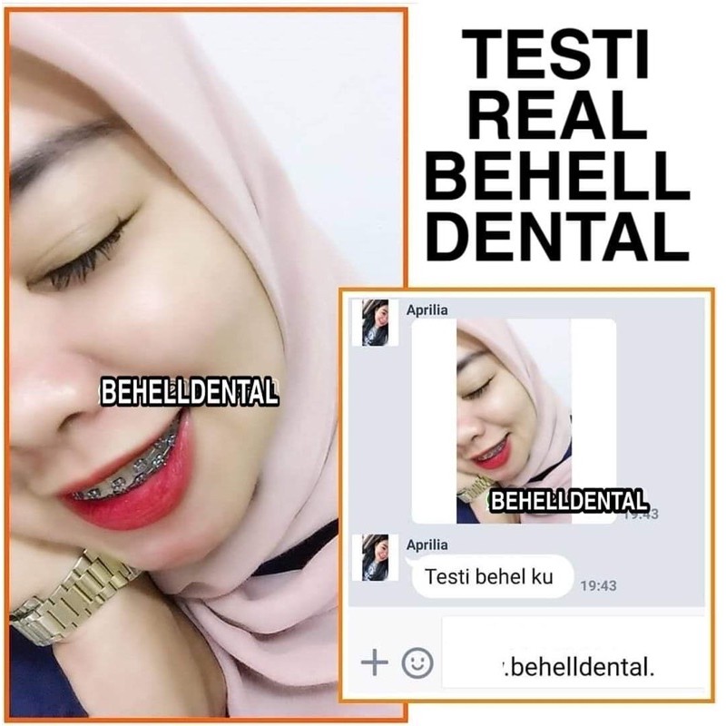 BEHELLDENTAL BRACKET BEHEL METAL GERMANY 345 HOOK . KAWAT GIGI ORTHO PERMANEN ROTH 022 BISA PERBAIKAN PERAWATAN GIGI - DENTAL